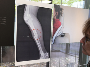 Se imprime “andamio” en 3D para regenerar huesos