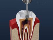 Endodoncia en la actualidad