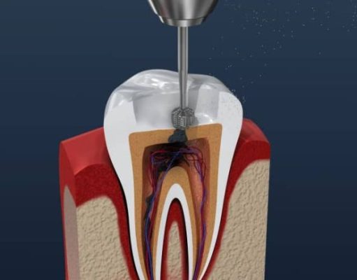 Endodoncia en la actualidad