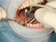 Principios básicos en implantes