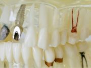 Aditamentos de sujeción en implantes y dientes naturales