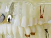 Aditamentos de sujeción en implantes y dientes naturales