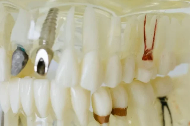 protesis dental