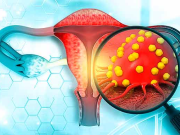 Seguir estrategia de la OMS para reducir el cáncer cervicouterino