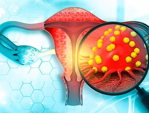 La Obesidad provoca Cáncer de Ovario