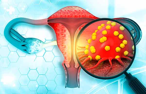 cáncer cervicouterino