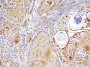 Proteínas presentes en la saliva ayudarían a detectar cáncer bucal
