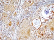 Proteínas presentes en la saliva ayudarían a detectar cáncer bucal