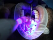 El láser en salud dental