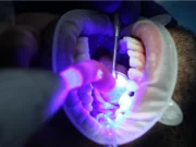 El láser en salud dental