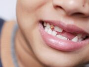 Ortodoncia en pacientes infantiles
